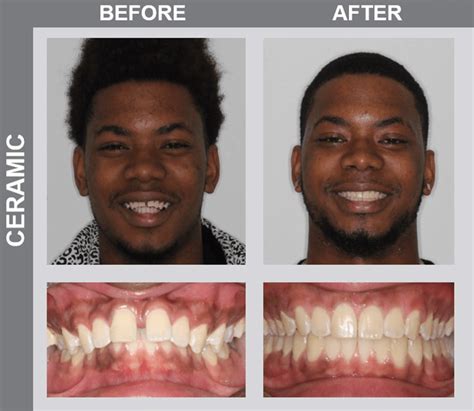 Teeth Before And After Braces Crowding