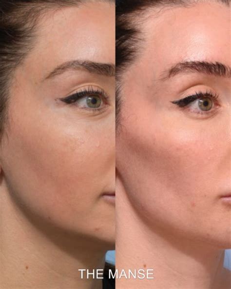 Cheek fillers before and after: Sydney dermal filler clinic