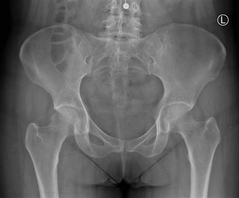 Pelvic Anatomy Xray : Interpreting X Rays Of The Pelvis Hip Joint And Femur Youtube - Each hemi ...