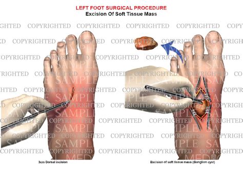 Surgical excision of left foot ganglion cyst – Medical Art Works