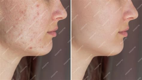 Premium Photo | Cropped shot of young womans face before and after acne treatment on face ...