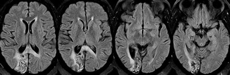 What is the most likely diagnosis in this 70 y/o w/ history of pontine infarct ~8 months ago now ...