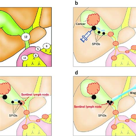 Sentinel lymph node identification-per node. | Download Scientific Diagram