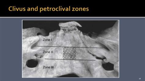 Petroclival Meningioma