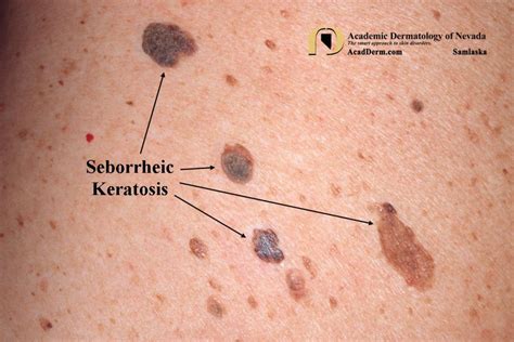 Seborrheic Keratosis: Barnacles of life... - Academic Dermatology of Nevada