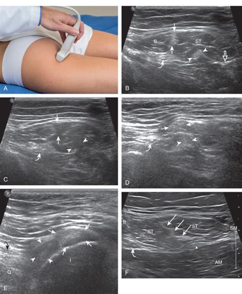 Hip and Thigh Ultrasound | Radiology Key