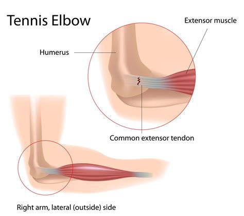 Tennis Elbow - Definition, Anatomy and Causes - Jeffrey H. Berg, M.D.