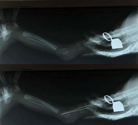 Paediatrics: Calcaneovalgus foot (0003470) – CSC Staff Teaching and Training