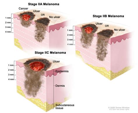 Melanoma Skin Cancer Stages