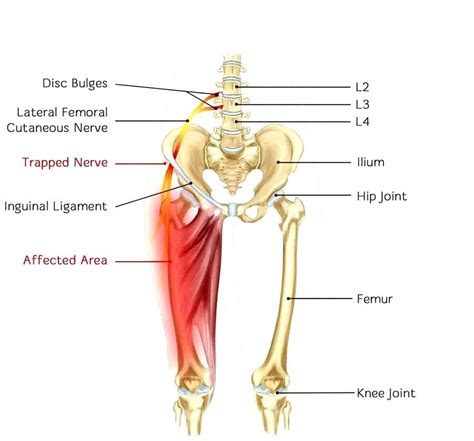 Pinched Nerve In The Hip Sciatica Clinic