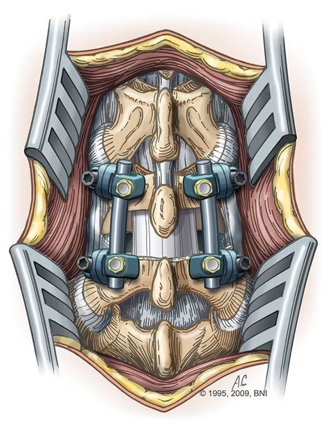 What is Spinal Fusion Surgery? | Barrow Neurological Institute