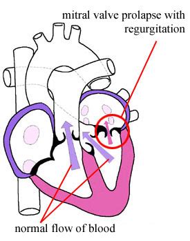 Mitral valve prolapse - Causes, Symptoms, Treatment and Prognosis