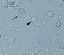 WBC and epithelial cells | eClinpath