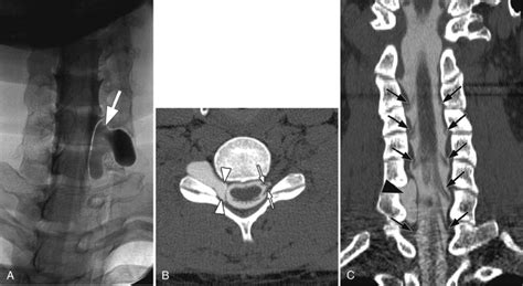 Tarlov Cyst | Radiology Key