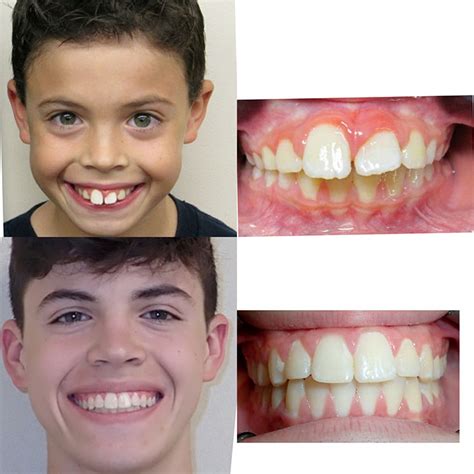 Before & After Braces | Wazio Orthodontics