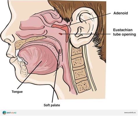 Adenoids, Adenoiditis, and adenoid hypertrophy (enlarged adenoids ...