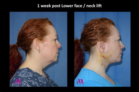 Lower face / neck lift – A M Aesthetic Surgery