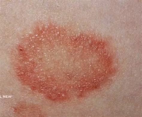 Ringworm – Images, Causes, Symptoms, Treatment | HubPages