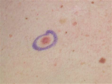 Amelanotic Melanoma: Symptoms, Causes, Treatment - Dr. Maral Skelsey