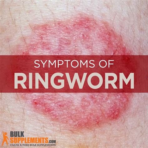 Ringworm: Symptoms, Causes & Treatment