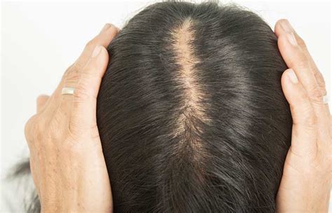 Androgenic Alopecia – Causes, Treatment, And More