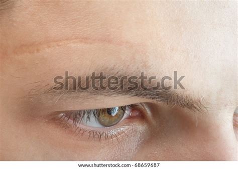 Scar On Forehead Stock Photo (Edit Now) 68659687