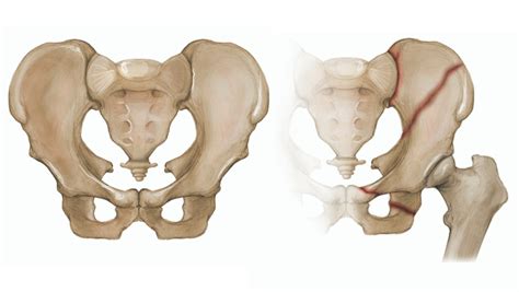 Pelvic Fractures - Georgia