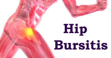 HIP BURSITIS SYMPTOMS, RELIEF AND PHYSICAL THERAPY - Rehab Experts