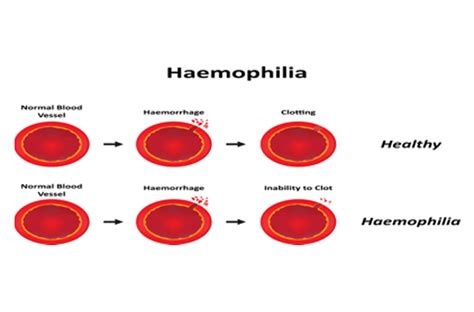 Genitic Disorder (Haemophilia)