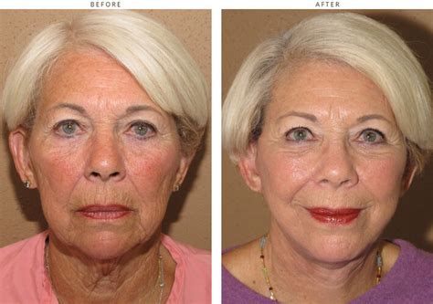 Mid Face Lift – Before and After Pictures * – Dr Turowski – Plastic Surgery Chicago