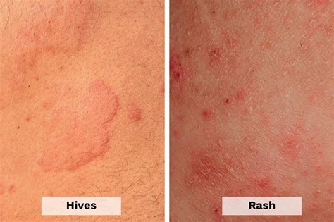 Hives vs. Rash: Here's How to Tell the Difference | The Healthy