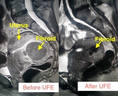 Large Fibroid Uterus Surgery