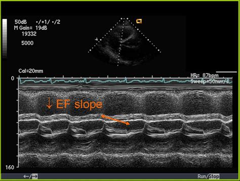 Mitral Valve Prolapse Echocardiography Wikidoc Mitral Valve Prolapse | Images and Photos finder