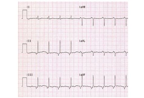 Recognizing Signs of Hypokalemia on ECG: Slideshow