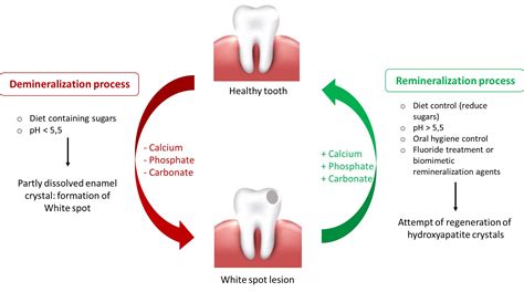 Demineralization And Remineralization Dynamics And Dental, 49% OFF