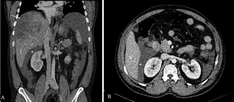 Hemoperitoneum. Contrast-enhanced coronal ( ) and axial ( ) CT scan in... | Download Scientific ...