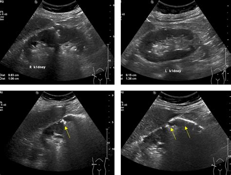 Emphysematous pyelonephritis – Radiology Cases