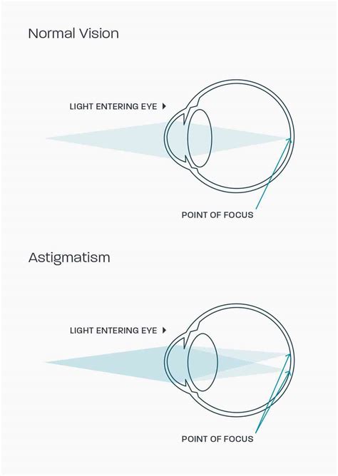 Astigmatism | Glasses Direct