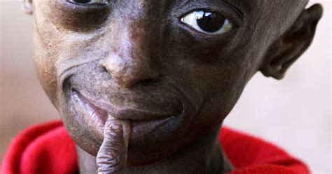 Progeria: First black child with rare aging disease - Photo 1 ...