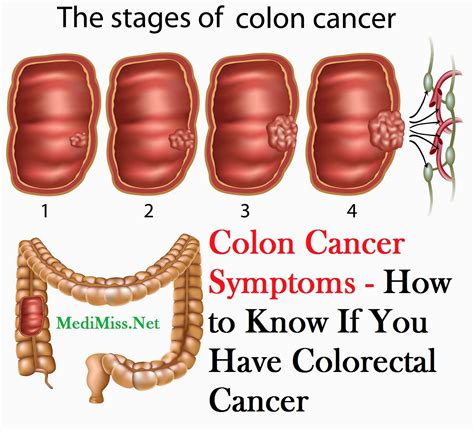 Colon Cancer Symptoms - How to Know If You Have Colorectal Cancer - MediMiss