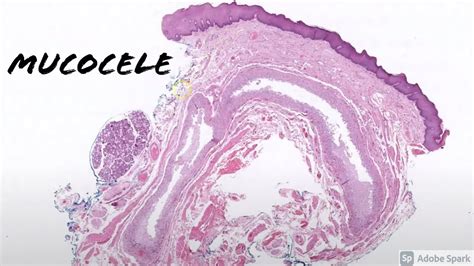 Mucous Retention Cyst Lip Histology | Sitelip.org