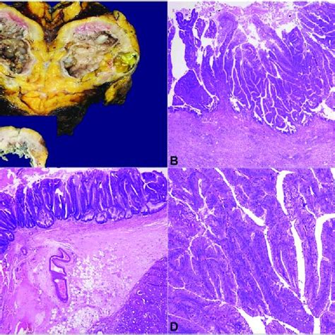 a and 1b: CT scanning showing RT Pyonephrosis with multiple stones and ...