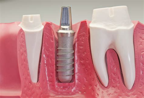 Dental Implants | Virginia Family Dentistry