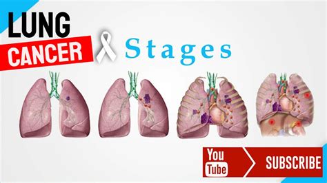 The Different Stages Of Lung Cancer - Male Health Clinic