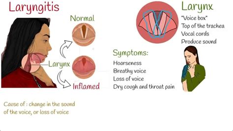 Understanding Laryngitis: Causes, Symptoms, And Treatment - Ask The Nurse Expert