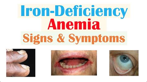 Best Of The Best Info About How To Check Anemia - Partnershipcopy26