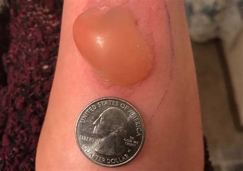 Michigan woman treated for brown recluse spider bite - CBS News