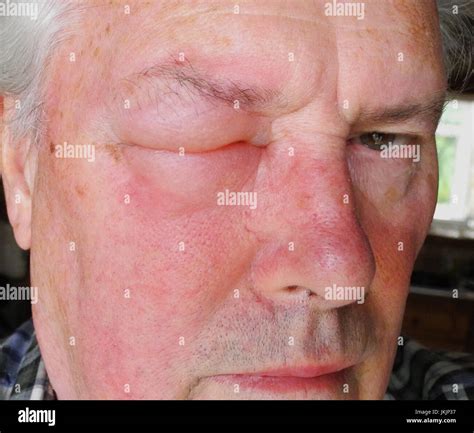 The image shows an allergic reaction to a wasp, bee, hornet, insect ...