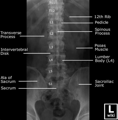 Lumbar Spine Radiographic Anatomy | Medical radiography, Radiology student, Diagnostic imaging