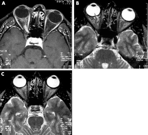 Normal Optic Nerve Mri